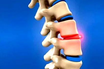 herniated