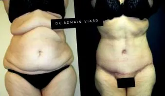 liposucția