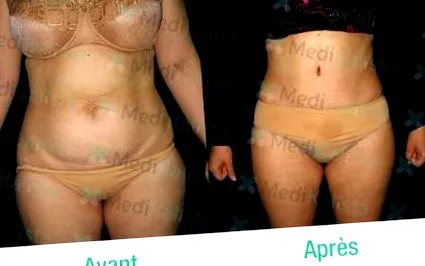 liposucție