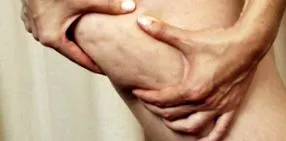 celulita