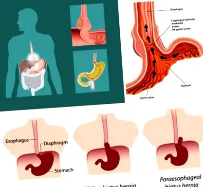 reflux gastroesophagealis