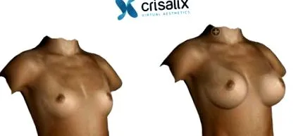 crisalix