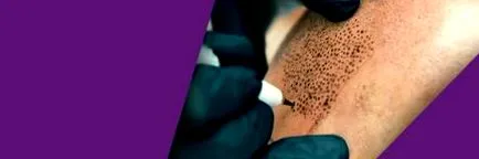 tricopigmentáció tricopigmentáció
