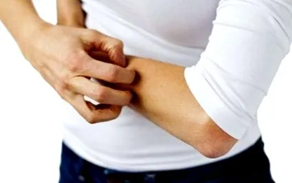 urticaria