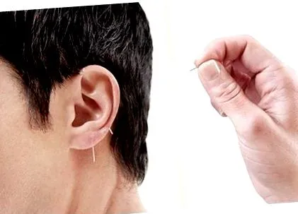 Acupunctura auriculară