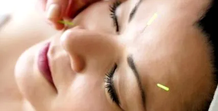 acupunctura