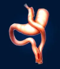 gastric către
