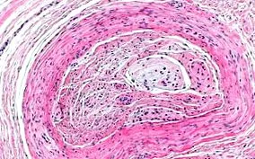 neuroma