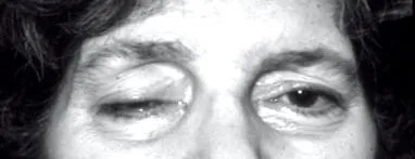 myasthenia