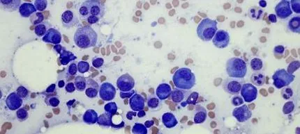 myeloma arccal