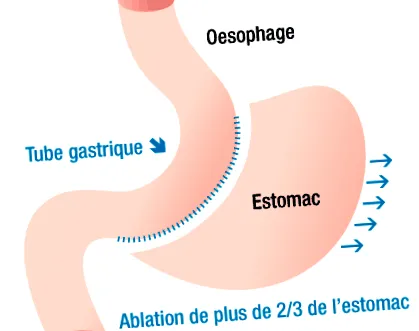 sleeve gyomor bypass