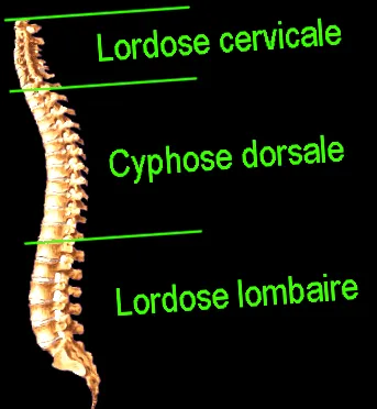 torticollis