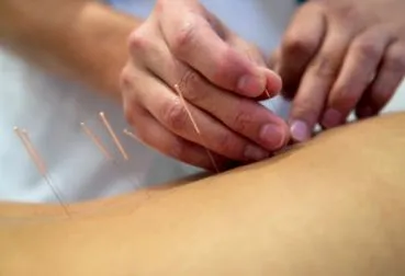 acupuncturii