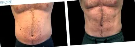 sziluett emsculpt