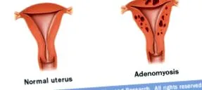 adenomyosis