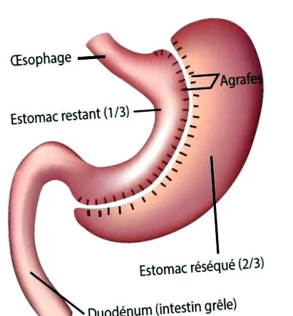 gastrectomie