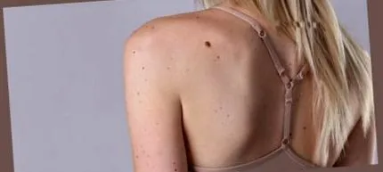 lanoma lehet