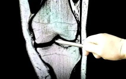 osteoporosis osteoporosis