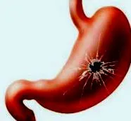 hagyományos ulcer