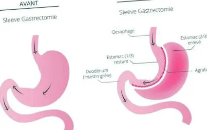 gastric