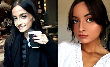 vereség anorexia