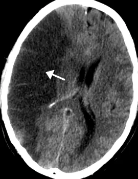 stroke