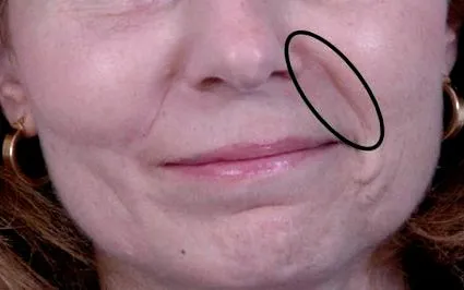 nasolabialis