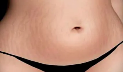 távolítsa
