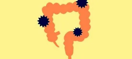 diverticula