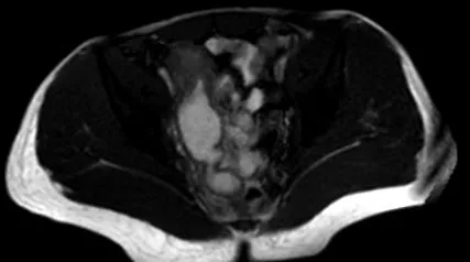 ileitis