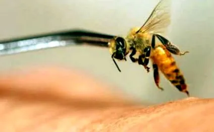 apipunctura
