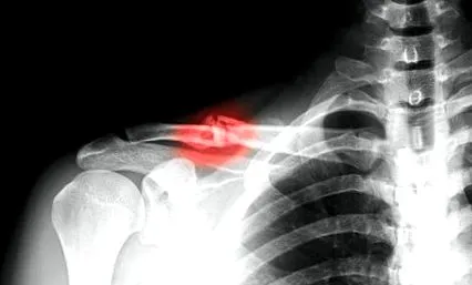 fractura
