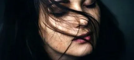 alopecia