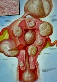 fibroamele fibroamele