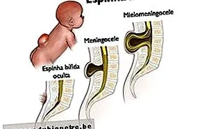 spina bifida