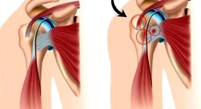 subacromialis