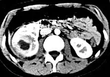 xanthogranulomatous