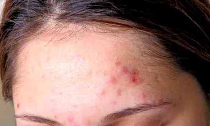 toxine