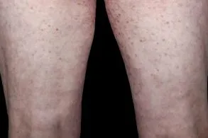 méhméreg