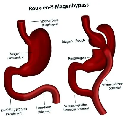 elhízási egyetemi