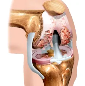 térdízület osteoarthritisje
