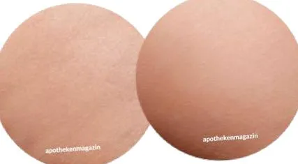 cellulit