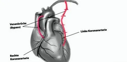 pectoris