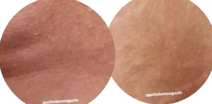 cellulit