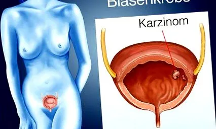 húgyhólyagrák tünetek