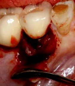 peri-implantitis