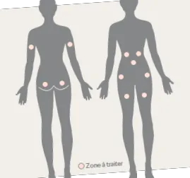cellulit