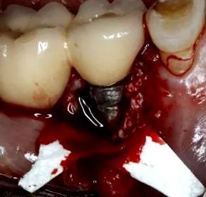 Implant Dent