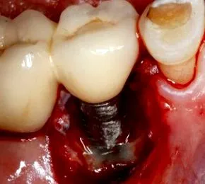 peri-implantitis