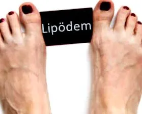 lipedema